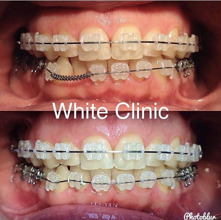 Выравнивание прикуса в WhiteClinic Работа ортодонта White Clinic