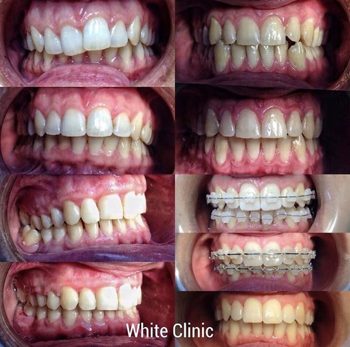 Выравнивание зубов. Брекеты Брекеты. Работа White Clinic
