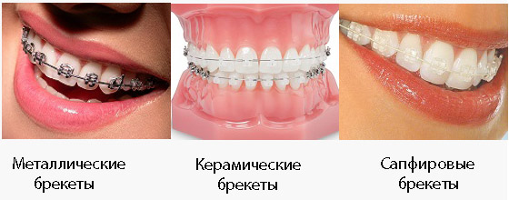 Виды брекетов Виды брекет систем. Пример