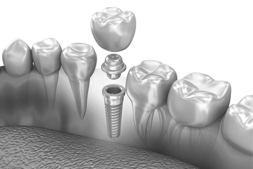 імплантація зубів стоматологічна допомога